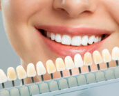 A woman selecting the shade of her teeth whitening at a dental clinic.